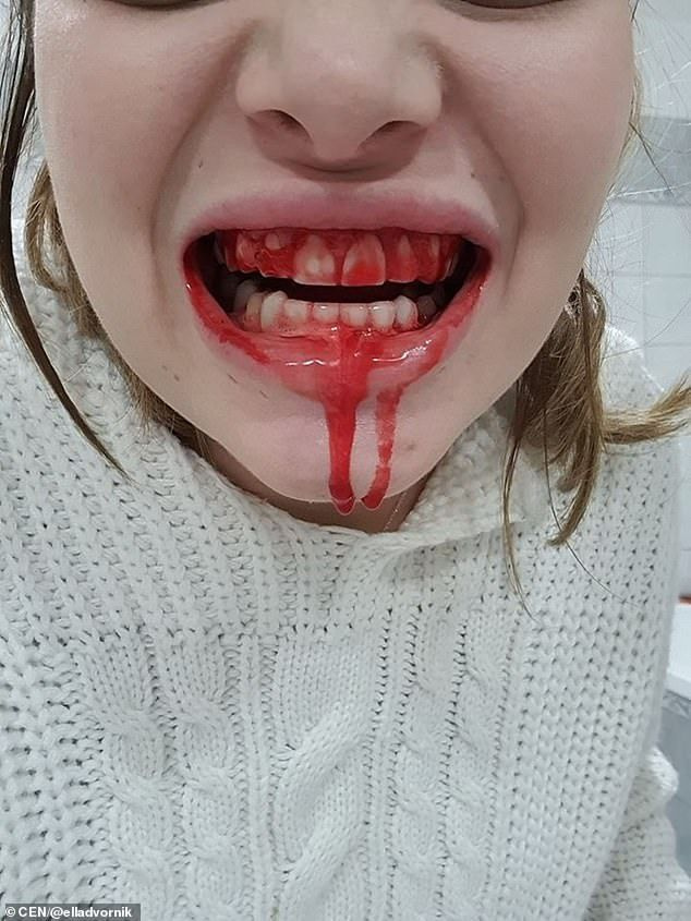 29-aastane Horvaatia Ella Dvornik postitas Facebooki šokeeriva foto oma verd täis suust ja ütles, et sellest on saanud