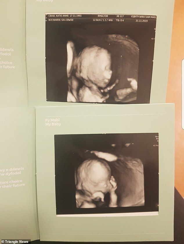 사진은 아기의 스캔 사진이며 Katie는 부부가 아기를 발견했을 때 인생의 충격을 받았다고 말했습니다.