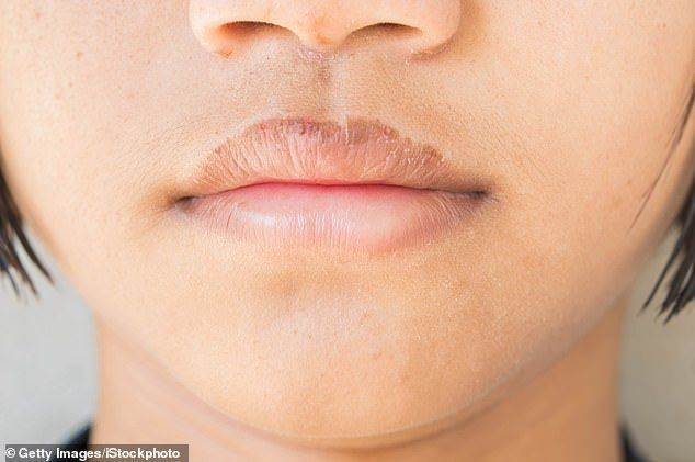 혁신적: NYC에 있는 CountryLiving.com의 수석 편집자인 Megan Stein은 갈라진 입술을 치료하기 위해 기저귀 발진 크림을 사용한 방법을 공개했습니다(사진).