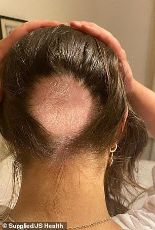 Noor naine on paljastanud, kuidas ta kaotas stressi tõttu tohutult juukseid ja nägi vaeva, et leida rohtu oma kunagiste tervete juuste jahmatava kaotuse vastu.