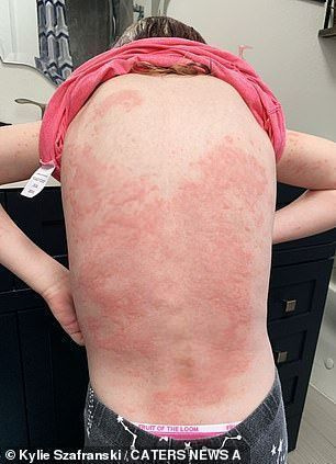 강은 감광성이지만 또한 알레르기 접촉 피부염으로 알려진 자외선 차단제에 알레르기 반응을 보입니다. 사진에서, 그녀의 등이 발진이 생겼습니다.