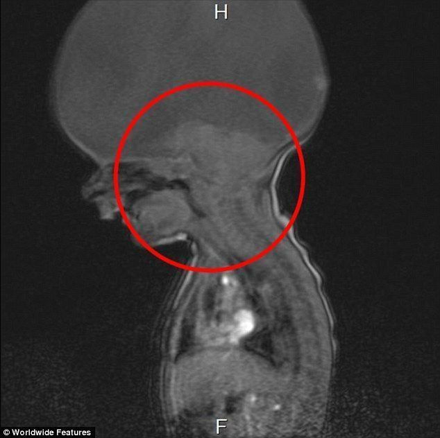 아론이 태어났을 때 찍은 이 엑스레이는 아론의 뇌가 원점에 도달했을 때 성장을 멈췄음을 보여줍니다. 그 위는 일반적으로 뇌가 두개골 구멍을 채우는 곳이지만 대신 액체로 채워져 있습니다.