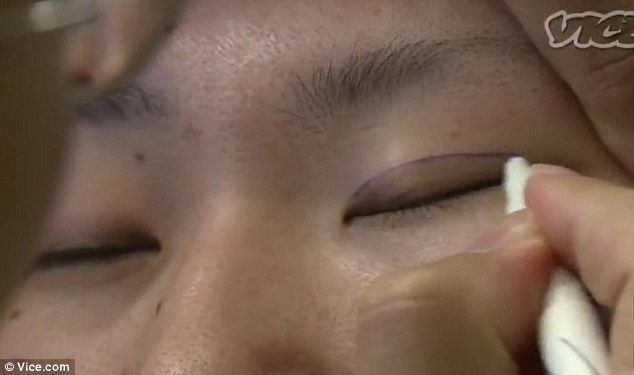 주름 만들기: 눈꺼풀 수술은 눈의 바깥쪽 끝을 잘라 눈을 더 넓고 둥글게 만드는 것으로 성형 외과 의사가 말하는 자신감을 높여줍니다.