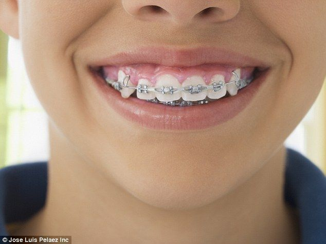 전문가에게 맡기세요: 의사들은 치아의 움직임은 집에서가 아니라 의사가 다루어야 하는 것이라고 주장합니다(대표 사진)