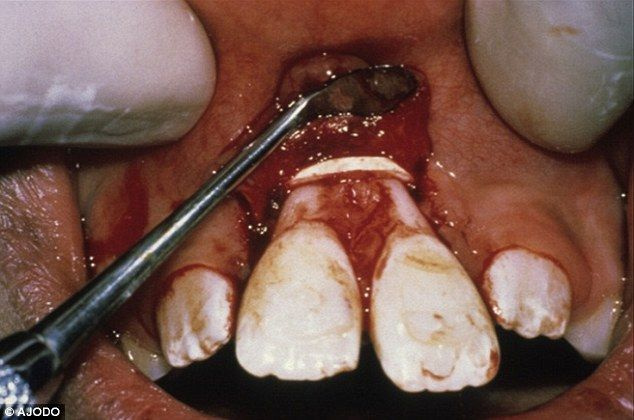 DIY 악몽: 소비자 경고는 치아에 고무줄을 사용하는 것이 실제로 효과적인 발치 방법이라고 설명합니다.