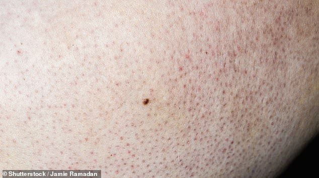 KP 또는 닭 피부로도 알려진 각화증은 모낭 주위에 케라틴이 축적되어 발생하는 완전히 무해한 피부 상태입니다.