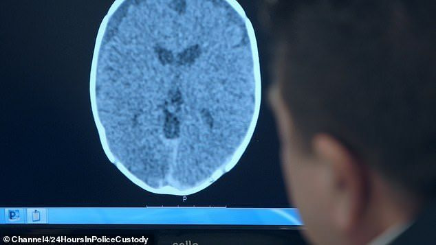 뇌에 출혈이 있는 부상당한 아기의 뇌 스캔(사진)